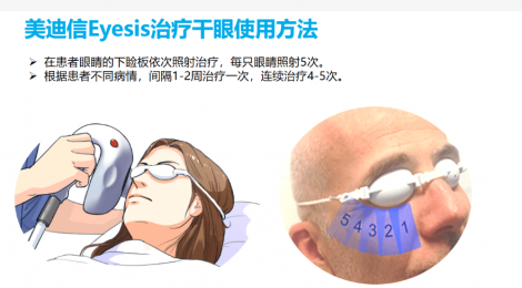 舒緩眼部不適， 干眼理療儀成為您的良好選擇