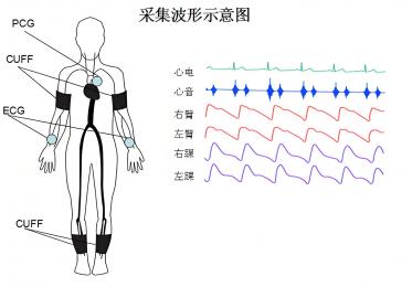 動脈硬化檢測儀的臨床意義，動脈硬化檢測儀的原理與技術！