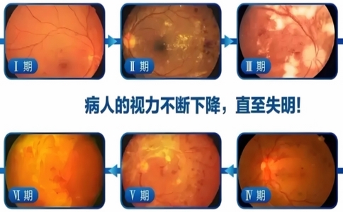 視網(wǎng)膜實力篩查儀