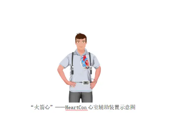 了解心臟體外輔助裝置（ECMO）的原理、應(yīng)用、優(yōu)勢