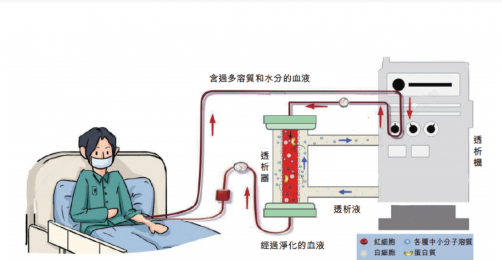 了解血液透析機的基本構(gòu)成、優(yōu)點和局限性