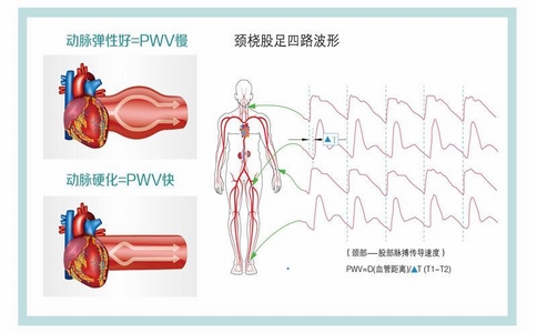 2025-02-13_動(dòng)脈硬化檢測儀_4