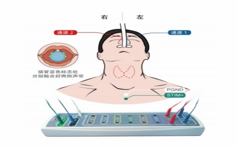 20250331_喉返神經(jīng)監(jiān)測(cè)儀_20250331_130356_6259 03-31-2025